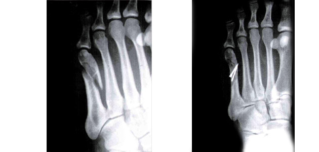 fracture 5ème métatarse pied fracture 5ème métatarse pied