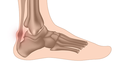 Le tendon d'Achille - Clinique du pied