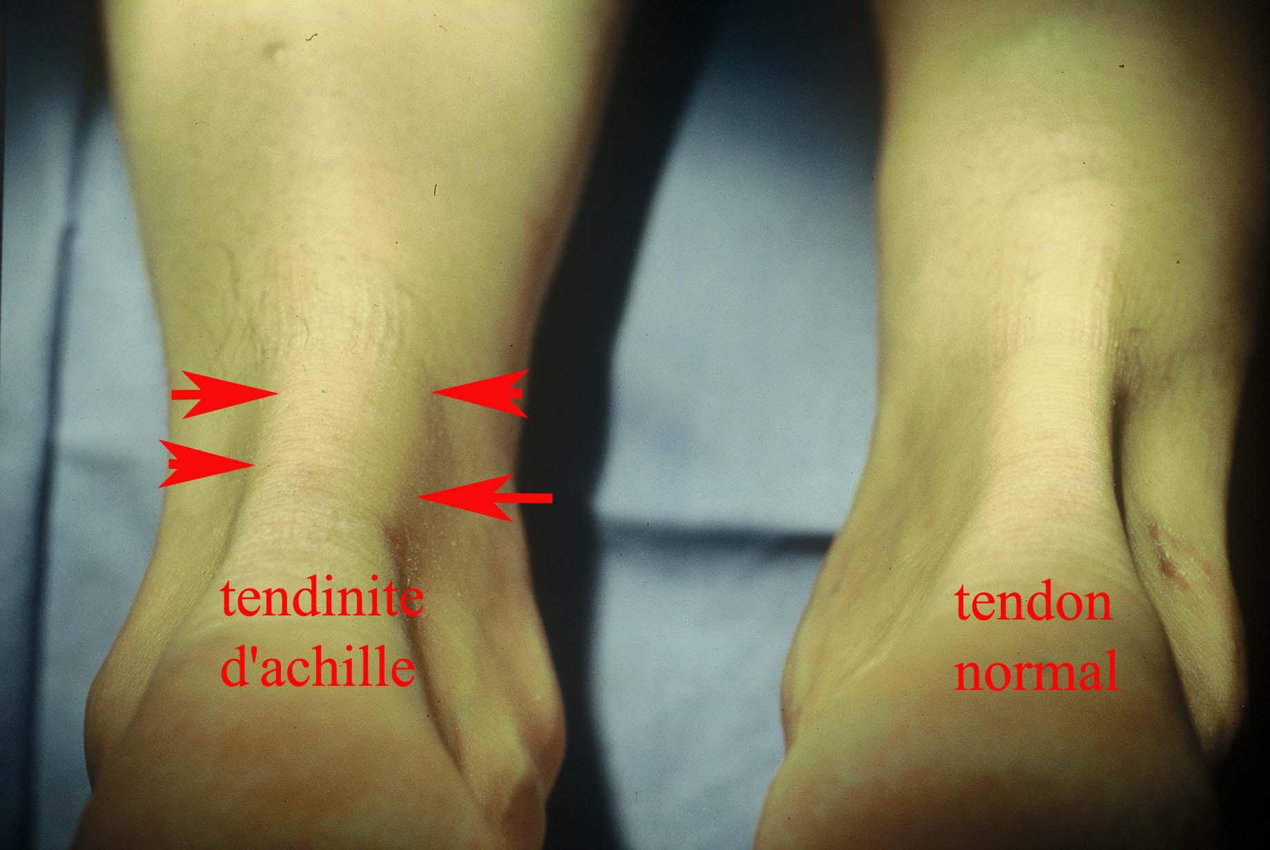Le tendon d'Achille - Clinique du pied