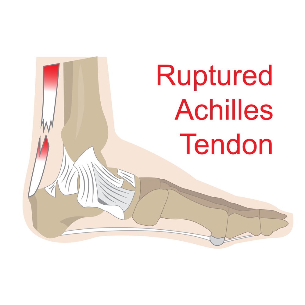 Le tendon d'Achille - Clinique du pied