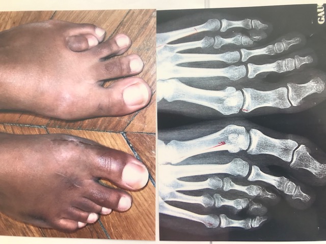 Brachymétatarsie Clinique du pied